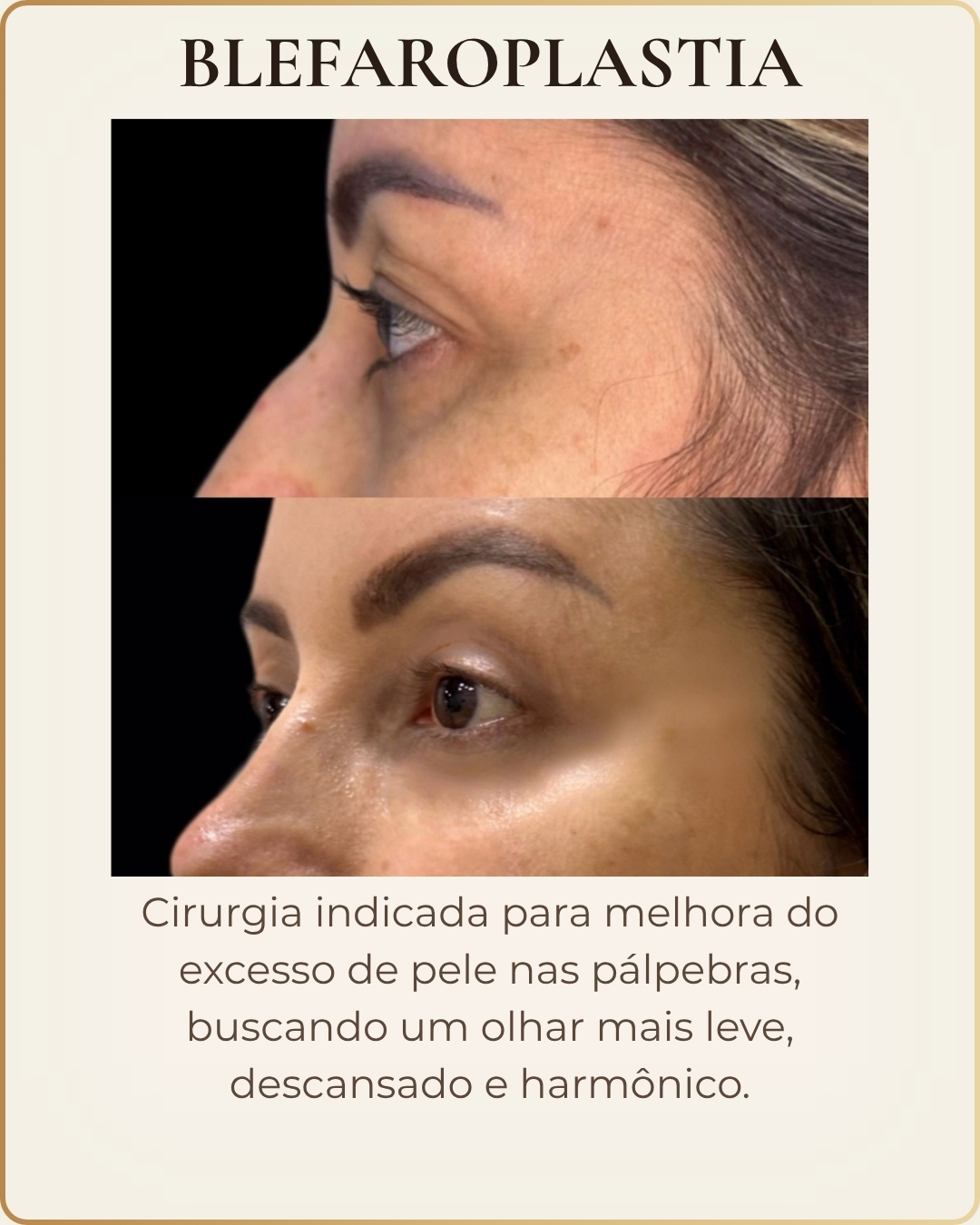 Blefaroplastia - caso clínico autorizado