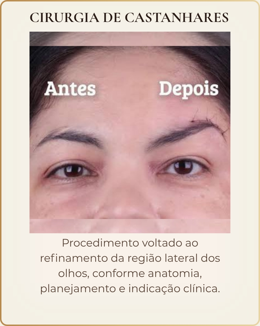 Cirurgia de Castanhares - caso clínico autorizado