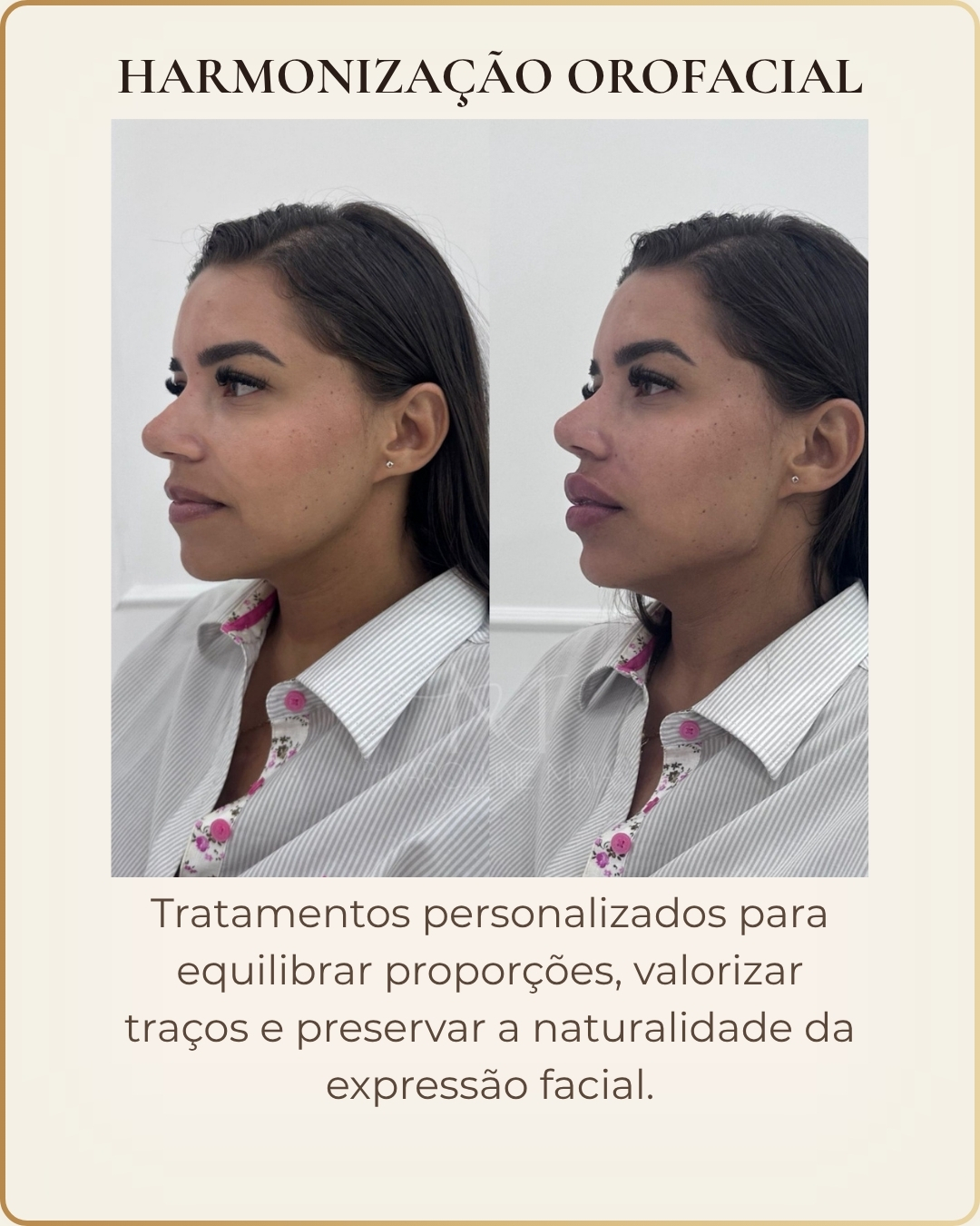 Harmonização Orofacial - caso clínico autorizado