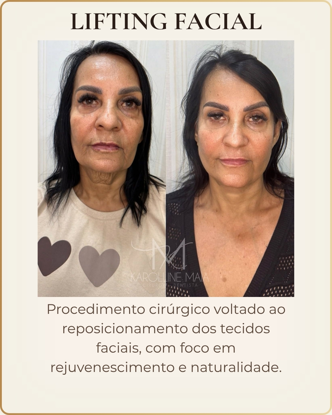 Lifting Facial - caso clínico autorizado
