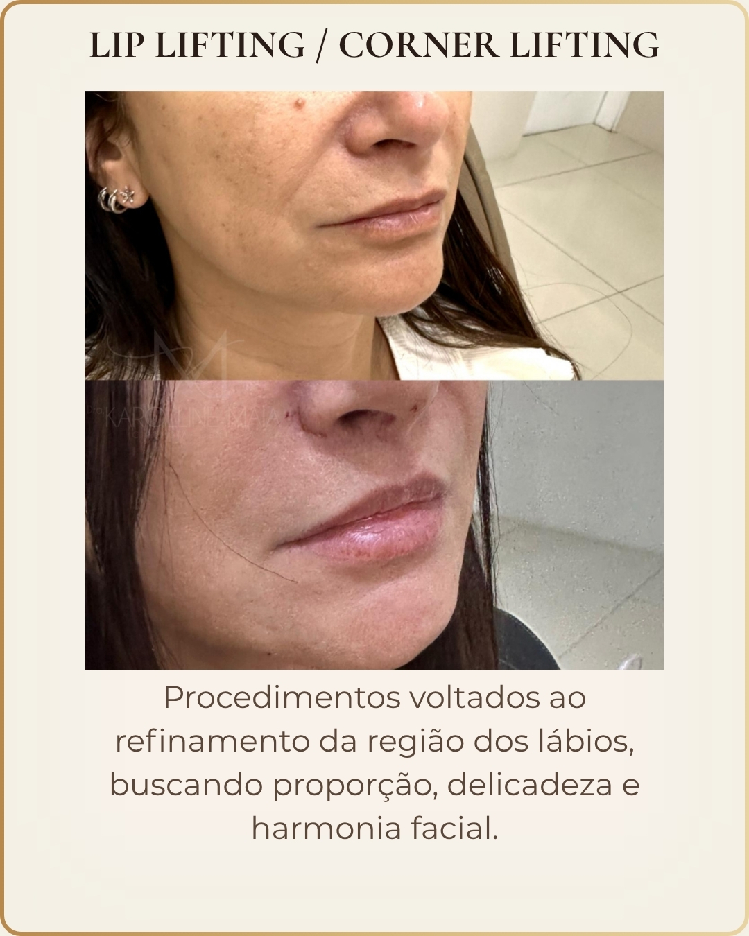 Lip Lifting e Corner Lifting - caso clínico autorizado