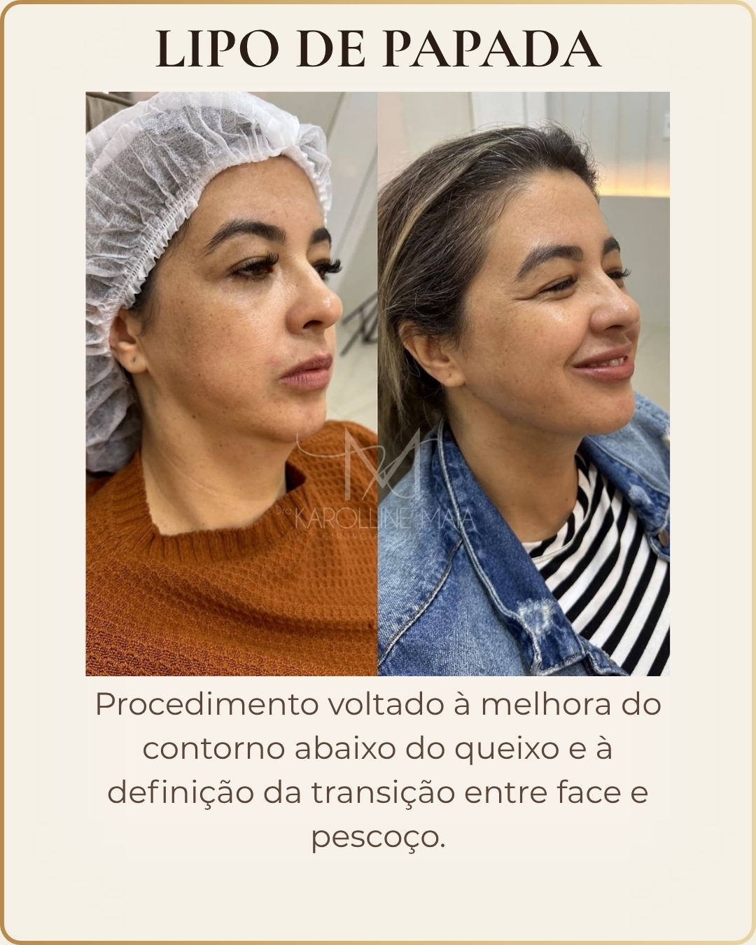 Lipo de Papada - caso clínico autorizado