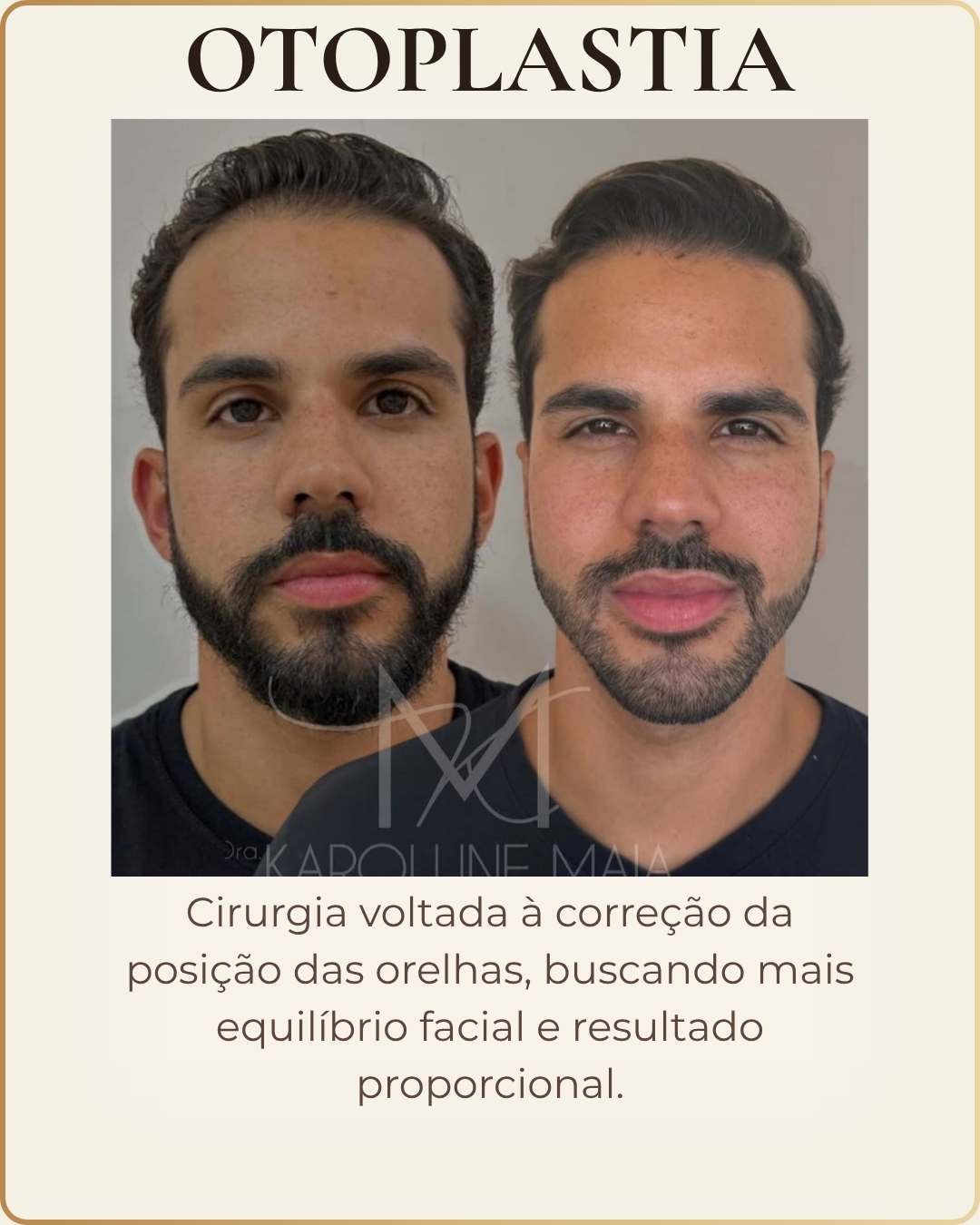 Otoplastia - caso clínico autorizado