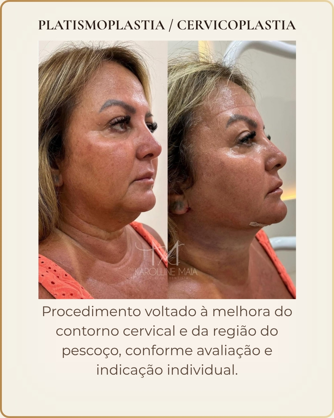 Platismoplastia e Cervicoplastia - caso clínico autorizado