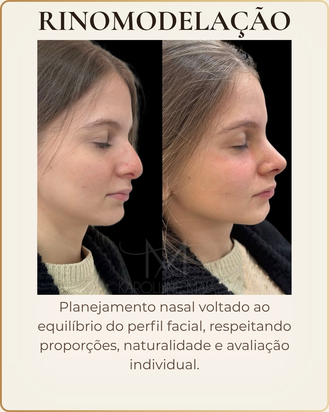 Rinomodelação - caso clínico autorizado