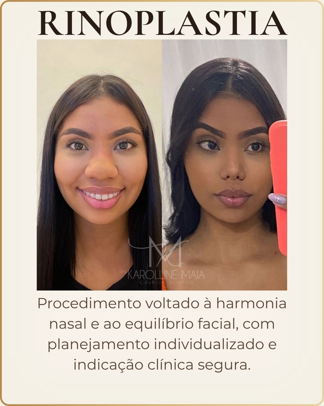 Rinoplastia - caso clínico autorizado